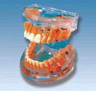 透明牙体病理模型YR-L1008