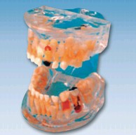 透明乳牙病理模型YR-L1006