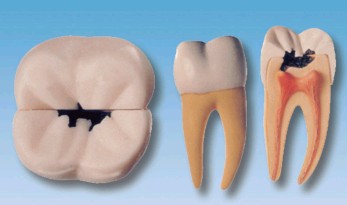 右侧第一颗磨牙蛀牙模型YR-L1002